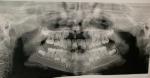 Сверхкомплект зубов фото 1