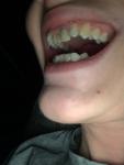 Улучшение внешнего вида зубов фото 2
