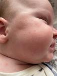 Аллергия или акне новорожденных фото 1