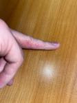 Сыпь, проявления на пальцах руки, красные участки кожи, пупырышки фото 3