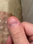 Чёрная точка под ногтем, и кровоизлияние на пальце фото 2