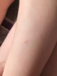Красные пятна шершавые у ребёнка, аллергия? фото 2