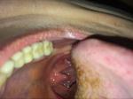Ком в горле, миндалины, лимфоузлы фото 1