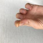 Трещины на коже, утолщение под ногтями пальцев рук фото 3