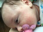 Цветение новорожденных или аллергия фото 1