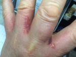 Волдыри на руке от аллергии фото 1