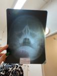 Искривление носовой перегородки, рентген носовых пазух расшифровать фото 2
