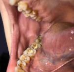 Лейкоплакия полости рта фото 1