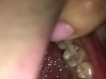 Болит зуб после лечения фото 2
