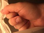 Сухой нарост на пальце руки около ногтя фото 1