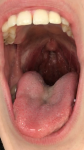 Ком в горле слева полгода, щелчок при глотании, кашель фото 1