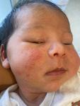 Сыпь на лице у новорождённого фото 1