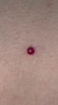 Красная кровяная точка 4-5 мм на груди фото 2