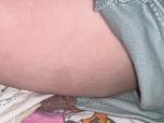 Гипо и гиперпигментированные пятна на теле ребёнка фото 1