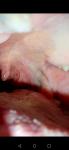 Боль в горле, справа белая полоса за мендалиной на слизистой фото 3