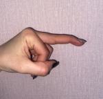 Палец кривой после перелома фото 3
