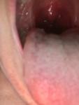 Боль в горле, увеличены миндалины фото 2