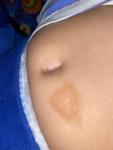 Светлокоричневые пятна на теле ребёнка фото 1