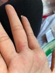 Меж пальцев болячка более месяца фото 2