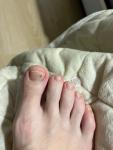 Пятно на ногте большого пальца ноги фото 1