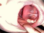 Белое пятно на зубе у ребёнка фото 1