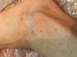 Появился дерматит на теле, больше всего высыпаний на ногах фото 3
