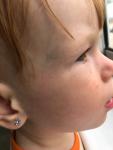 Сыпь у ребенка в виде коричневых точек на висках фото 2