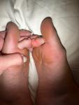 Посинели пальцы на ногах фото 2