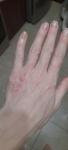 Мелкие, водянистые пузыри на коже рук, сильный зуд и раны фото 1