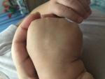 Шишка на кисте руки у ребенка фото 2