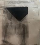 Дисплазия тазобедренных суставов выставили в 3 месяца по рентгену фото 1