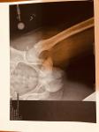 Перелом передне нижней подвздошной кости фото 3