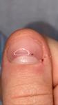Чёрная точка под ногтем, и кровоизлияние на пальце фото 4