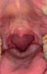 Ком в горле после тонзиллэктомии фото 1