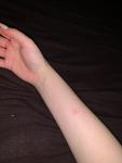 Прыщ на руке, зуд, пониженный иммунитет фото 2