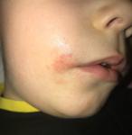 Красное пятно из мелкой сыпи на лице у ребёнка фото 2