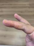 Экзема или дерматит на пальцах рук фото 2