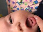 Кандидоз полости рта у младенца фото 2