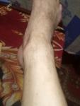 Боль неясного происхождения на пальце ноги фото 2