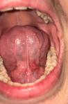 Воспаление под языком, 4 дня фото 1