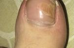 Пятно на ногте большого пальца ноги фото 1