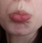 Красное пятно и уплотнение внутри губы фото 1