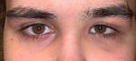 Разные глаза после травмы фото 2