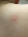 Красные пятна у ребёнка похожие на укусы комара фото 2