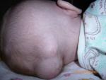 Большие шишки на голове у 2х месячного ребенка фото 1