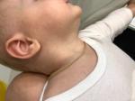 Сыпь на шеи и груди ребёнок 7 месяцев фото 4