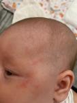 Сыпь у новорождённого ребёнка фото 3