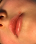 Высыпание возле рта ребенка фото 1