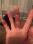 Опух палец и образовалась гематома фото 1