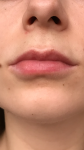 Сосуд и лонгидаза при увеличении губ фото 2